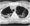 polmonite eosinofila acuta